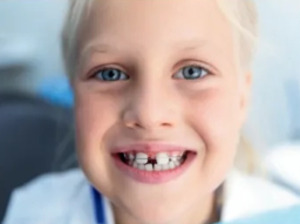 DENTAL CARE IRELAND: Straight Talk on Kid’s Braces